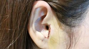 一名女子在鼻子手术中不知情地切除了一部分耳朵