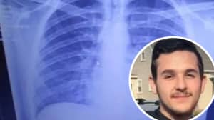 令人震惊的X射线表明青少年的肺部充满了“烟气中的固化油”