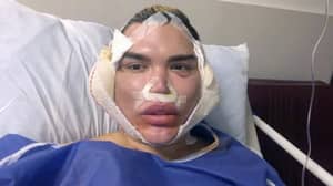 '人类肯娃娃'Rodrigo Alves在修订手术后警告人们关于面部程序