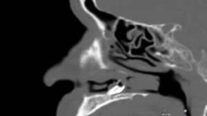人发现鼻子被阻塞是由鼻孔生长两年引起的
