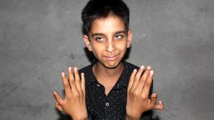 十二岁的男孩在他的双手上有一个额外的拇指