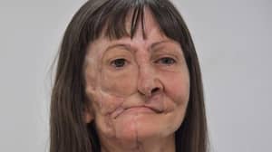 皮肤癌患者的生活在她的脸上的“缺失”取代了分层后改变
