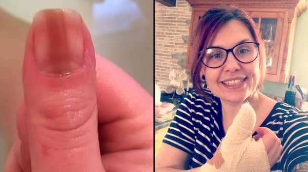 36岁的女人，谁在指甲盖上“尴尬”线路告诉它是罕见的癌症
