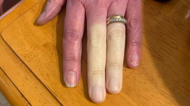 由于罕见的疾病，妈妈的手指变得完全相同