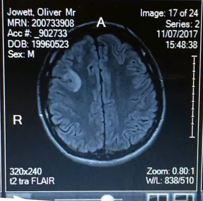 Ollie的脑肿瘤扫描。学分：SWNS“width=
