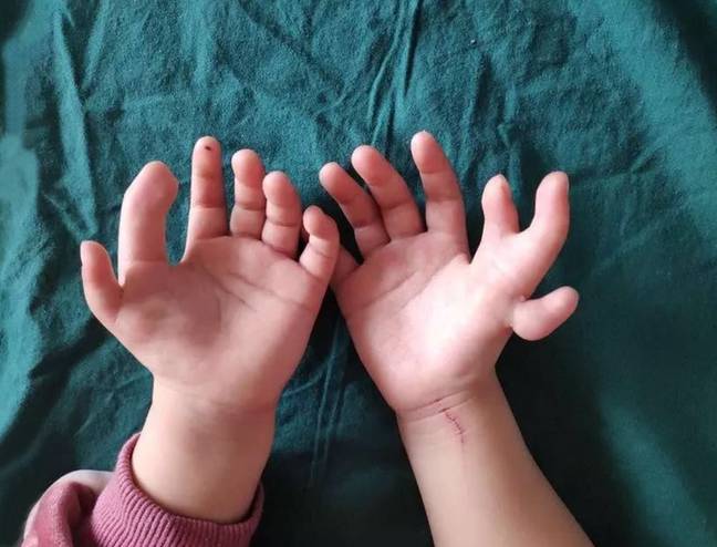 这个三岁的中国女孩有13个手指。信用：亚洲武器