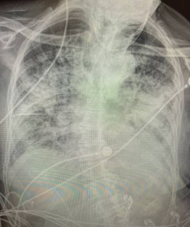Bankhead-Kendall博士分享了Covid患者X射线检查的照片。信用：Twitter