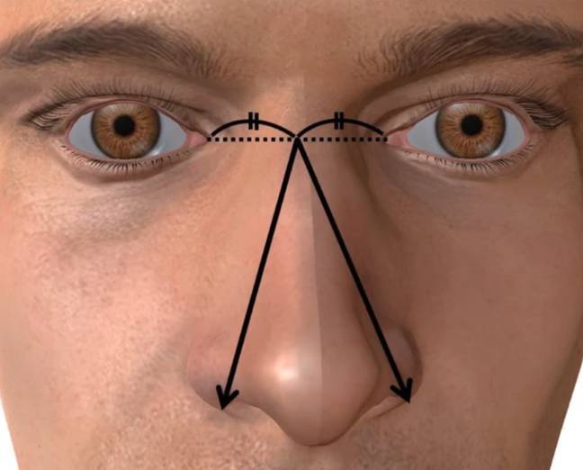 鼻子尺寸被定义为左侧和右侧内侧角度和左侧或右鼻翼外部的中点之间的较长距离。学分：基础和临床疾病