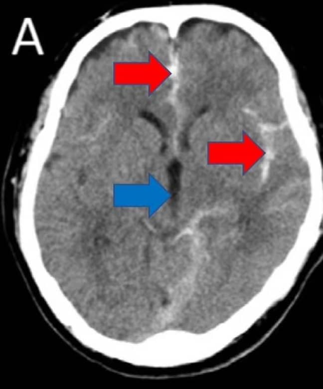 一个CT扫描显示男人遭受的卒中。信誉：名古屋市大学/中风和脑血管病杂志