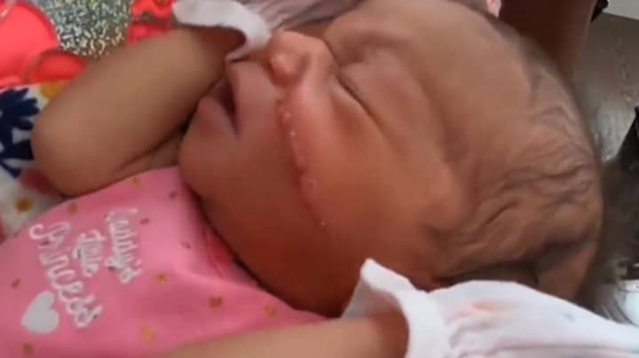 婴儿在剖腹产后留下了巨大的割伤脸“width=