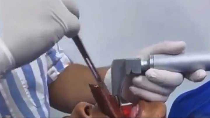 哥伦比亚的医生从男人的喉咙中删除了18厘米的鱼“imgWitdh=