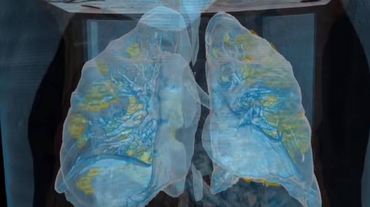 视频显示冠状病毒对肺部的毁灭性影响