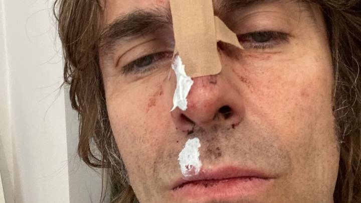 利亚姆·加拉格尔（Liam Gallagher）从直升机上摔下后发现受伤