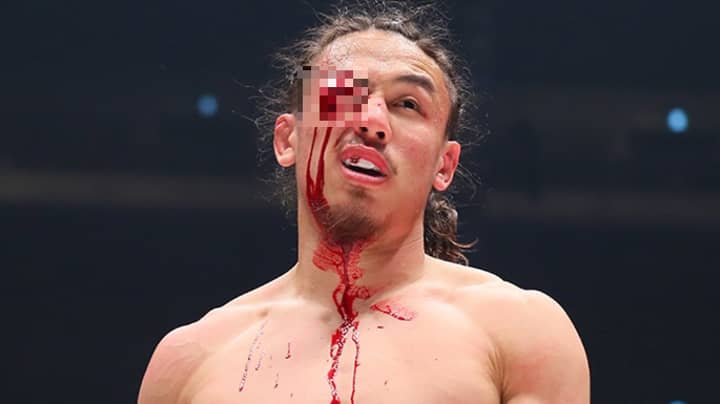 MMA-Fighter Yusuke Yachi在梅威瑟（Mayweather Nasukawa）抓住令人毛骨悚然的眼睛伤害“imgWitdh=