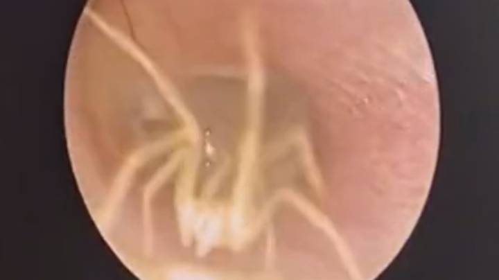 医生发现蜘蛛在女性耳道内部刺痛