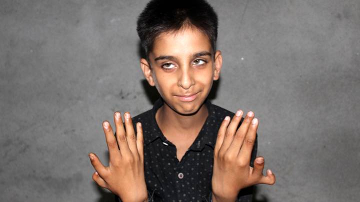 12岁的男孩双手多了一个拇指