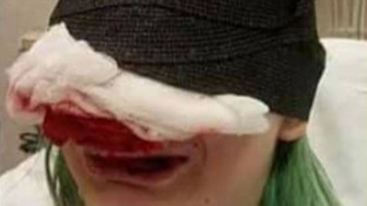 一名土地管理局的抗议者在她的鼻子被撕掉后向警方提起诉讼